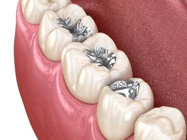 Amalgam restorasyonu. Diş konseptinin tıbben doğru 3 boyutlu animasyonu