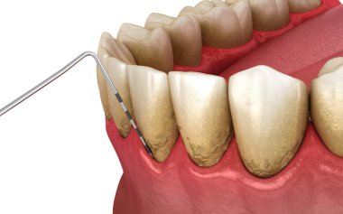 Periodontit testi, sakız resesyonu. Tıbbi olarak doğru 3B illüstrasyon