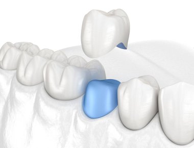 Azı dişinin üzerine porselen kaplama yerleştirilmiş. Tıbbi olarak doğru 3B illüstrasyon