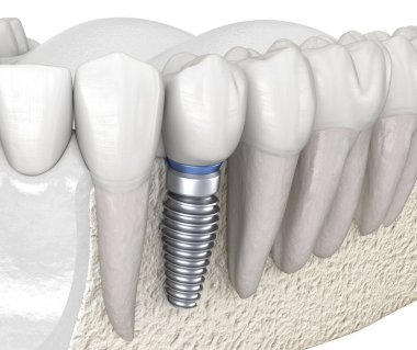 İmplantla azı dişi alınıyor. İnsan dişleri ve protez kavramının tıbben doğru üç boyutlu çizimi