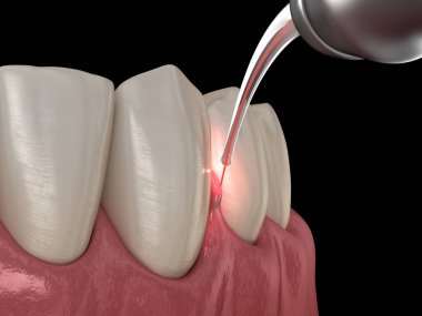 Lazerle sakız düzeltme ameliyatı. Tıbbi olarak doğru diş 3D illüstrasyon