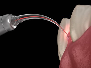 Lazerle sakız düzeltme ameliyatı. Tıbbi olarak doğru diş 3D illüstrasyon