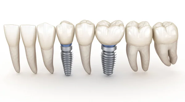 Diş Implantları Devrede Nsan Dişlerinin Boyutlu Illüstrasyon Kavramı — Stok fotoğraf