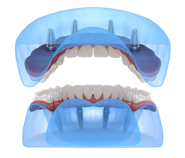 上颌骨和下颌骨假体均在4个系统上 由植入物支持 医学上准确的人类牙齿和假牙3D图像 — 图库照片