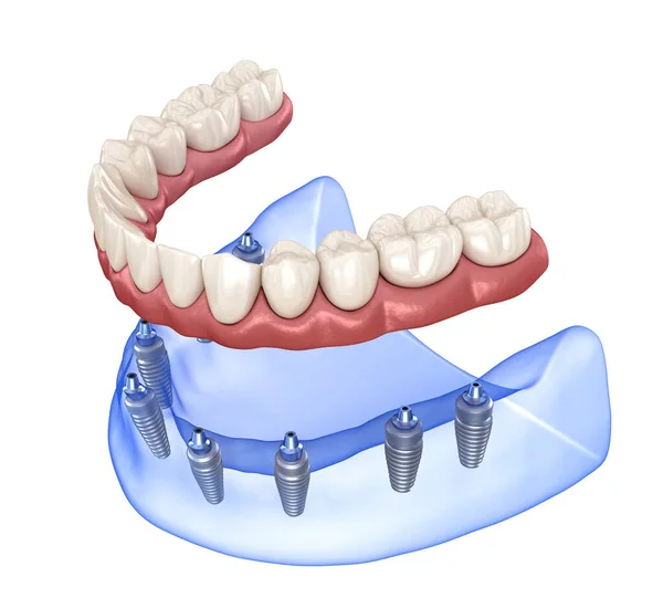 Prótesis Maxilar Mandibular Con Encía Sistema All Soportado Por Implantes — Foto de Stock