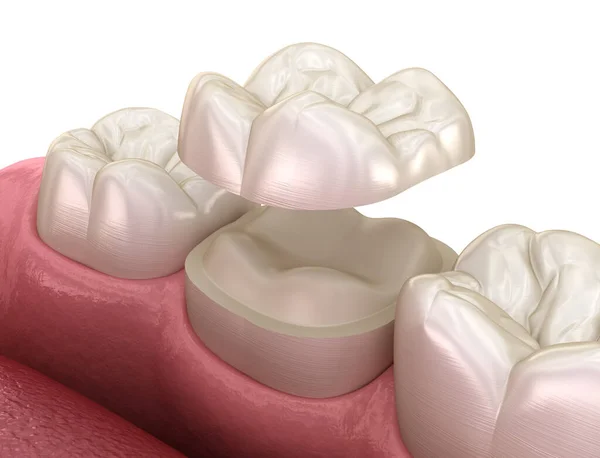 将陶瓷冠固定在磨牙上 医学上准确的人类牙齿治疗三维图像 — 图库照片