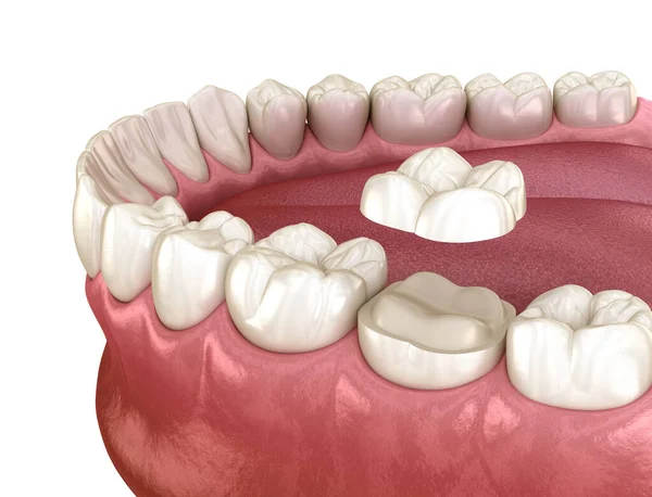 将陶瓷冠固定在磨牙上 医学上准确的人类牙齿治疗三维图像 — 图库照片