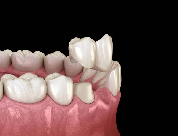 Ponte Sbalzo Ceramica Recupero Dente Frontale Animazione Clinicamente Accurata Del — Foto Stock