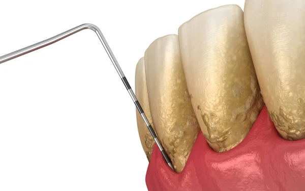 Parodontitis Test Zahnfleischrezession Medizinisch Korrekte Darstellung — Stockfoto