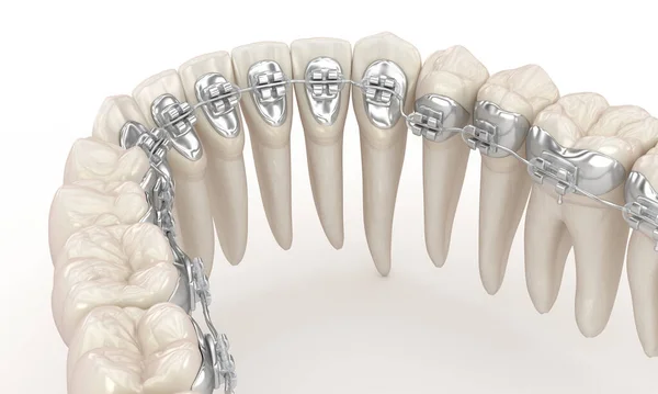 Linguale Zahnspange Illustrationskonzept Für Silberne Zahnspangen — Stockfoto