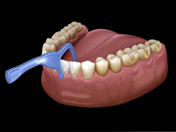 口腔衛生 歯から立ち往生食品を削除するためにつまようじデンタルフロスを使用しています 医学的に正確な歯科3Dイラスト — ストック写真