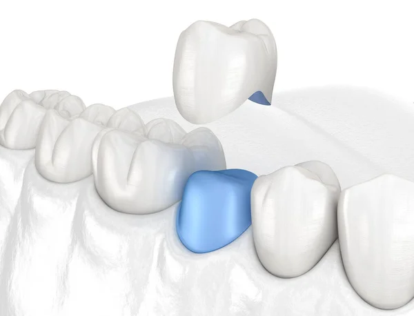 Colocación Corona Porcelana Sobre Diente Premolar Ilustración Médicamente Precisa —  Fotos de Stock