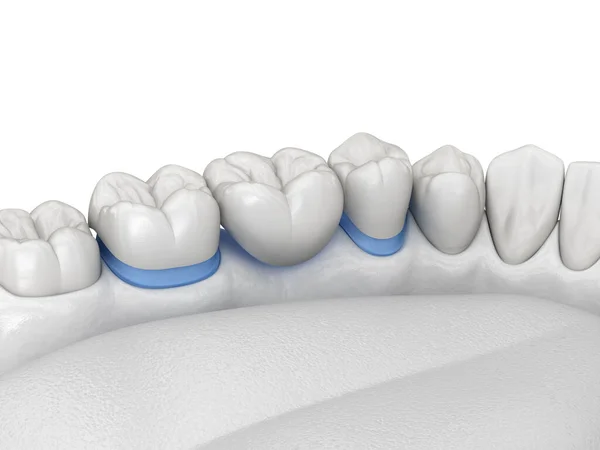 Porcelanowy Most Stomatologiczny Zębami Trzonowymi Przedtrzonowymi Medycznie Dokładna Ilustracja Leczenia — Zdjęcie stockowe