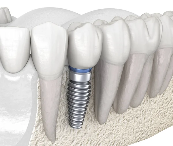 Recuperación Dental Preremolar Con Implante Ilustración Médicamente Precisa Del Concepto —  Fotos de Stock