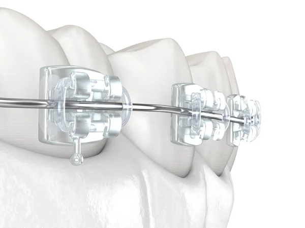 Dentes Aparelhos Claros Ilustração Odontológica Medicamente Precisa — Fotografia de Stock