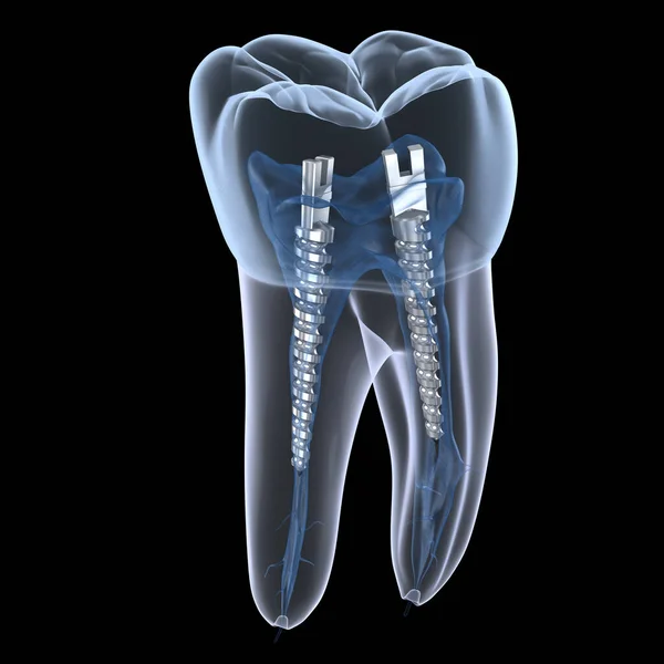 Tandstålstolpe Inuti Kindtänder Röntgenvy Dental Endodontisk Behandling Illustration — Stockfoto