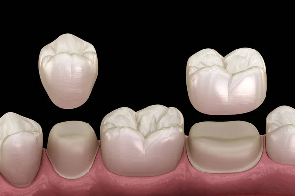 Colocación Coronas Porcelana Sobre Dientes Premolares Molares Ilustración Médicamente Precisa — Foto de Stock