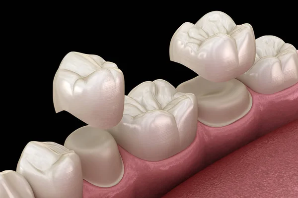 Colocación Coronas Porcelana Sobre Dientes Premolares Molares Ilustración Médicamente Precisa —  Fotos de Stock