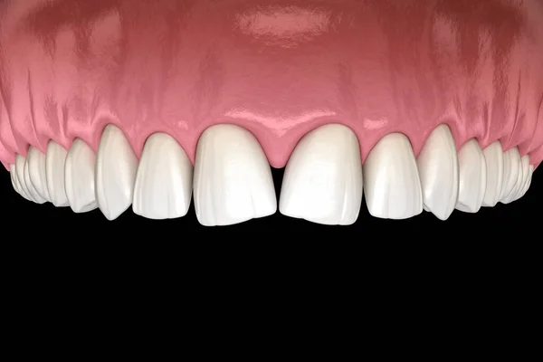 앞니에 부종이야 Dental Disfunction Illustration 컨셉트 — 스톡 사진