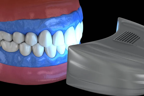 Proffesioinal Zęby Wybielanie Światło Aktywacja Wybielanie Zębów Koncepcja Ilustracji — Zdjęcie stockowe