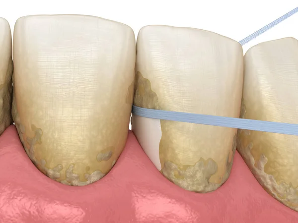 Proces Czyszczenia Nici Dentystycznej Medycznie Dokładna Ilustracja Higieny Jamy Ustnej — Zdjęcie stockowe