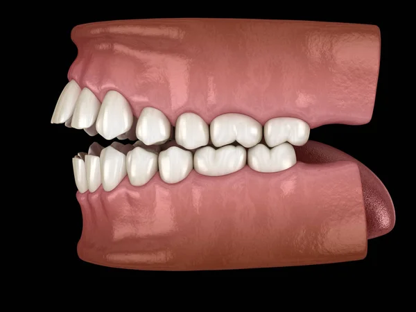 Ανοιχτή Οδοντική Απόφραξη Malocclusion Των Δοντιών Ιατρικά Ακριβές Δόντι Εικονογράφηση — Φωτογραφία Αρχείου