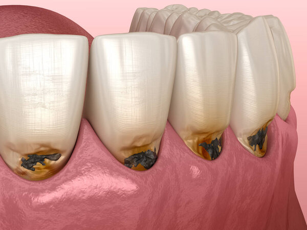 Кариес на лобных зубах. Медицинская точность трехмерной иллюстрации зубов.