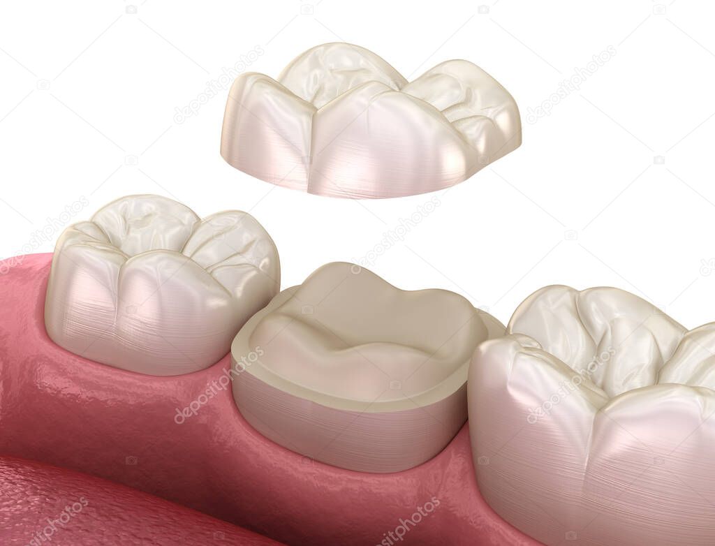 Fijación de corona de cerámica onlay sobre diente molar. Ilustración 3D
