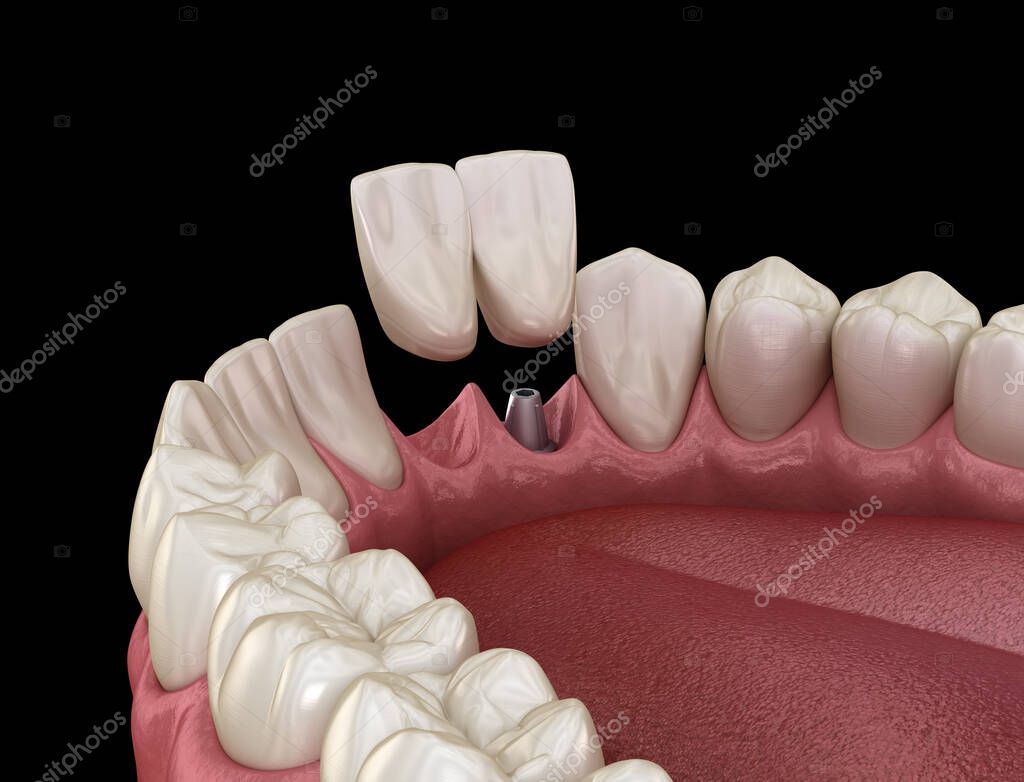 Cantilever bridge implant based, frontal tooth recovery. Animación 3D
