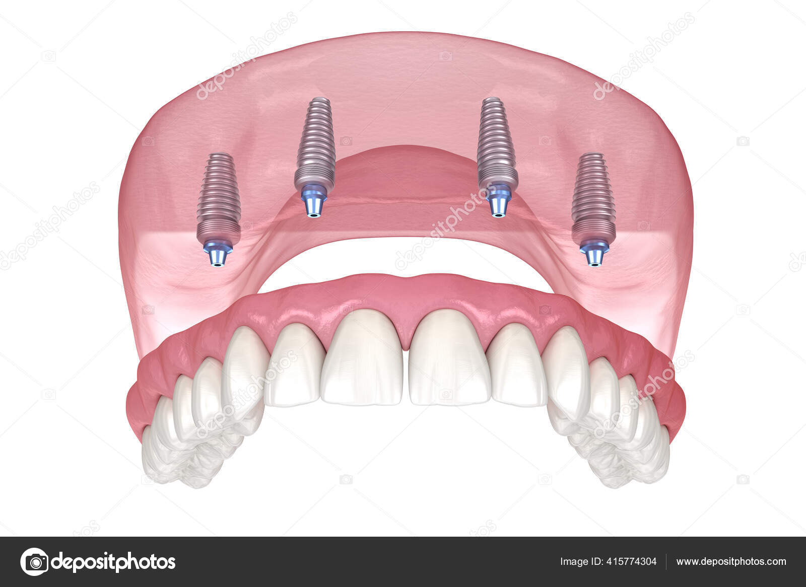 Prótese Mandibular Maxilar Tudo Sobre Sistema Suportado Por, mandibula e  maxilar 