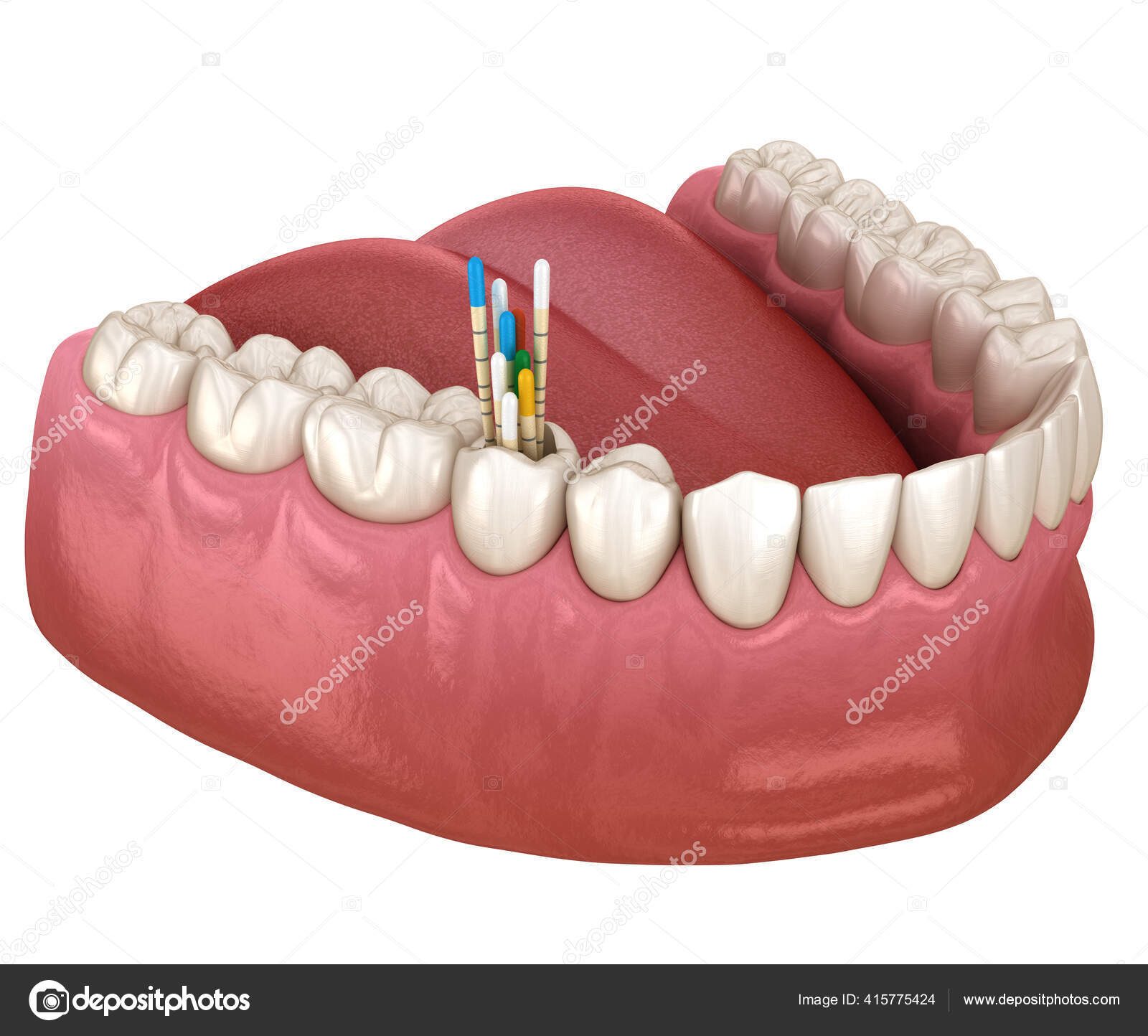 Gutta Percha Root Canal Treatment Process Medically Accurate Tooth