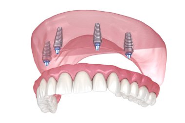 Çikletli Maxillary protezi. Hepsi de implantlarla desteklenen 4 sistemde. İnsan dişlerinin ve protezlerinin tıbbi açıdan doğru üç boyutlu çizimi