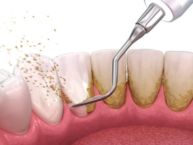 Ağız temizliği: Ölçekleme ve kök planlama (geleneksel periodontal terapi). İnsan diş tedavisinin tıbbi açıdan doğru üç boyutlu çizimi