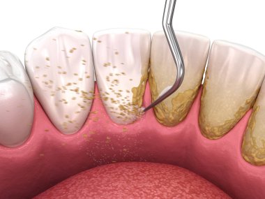 Ağız temizliği: Ölçekleme ve kök planlama (geleneksel periodontal terapi). İnsan diş tedavisinin tıbbi açıdan doğru üç boyutlu çizimi