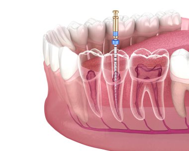 Endodontik kanal tedavisi. Tıbbi olarak doğru diş 3D illüstrasyon.