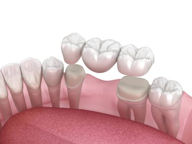 Dental bridge of 3 teeth over molar and premolar. Medically accurate 3D illustration of human teeth treatment clipart