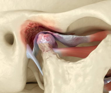 Temporomandibular eklem iltihabı ve yerinden çıkmış eklem diski. Tıbbi olarak doğru 3B illüstrasyon.