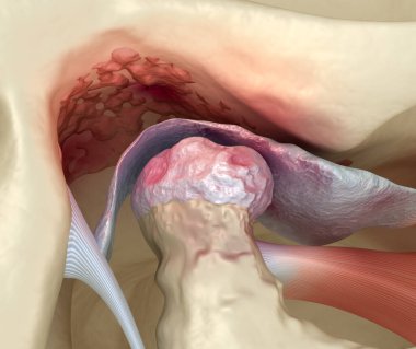 Temporomandibular eklem iltihabı ve yerinden çıkmış eklem diski. Tıbbi olarak doğru 3B illüstrasyon.