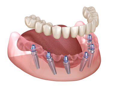 Çikletli çene protezi. Hepsi de implantlarla desteklenen 6 sistemde. İnsan dişleri ve protez kavramının tıbben doğru üç boyutlu çizimi