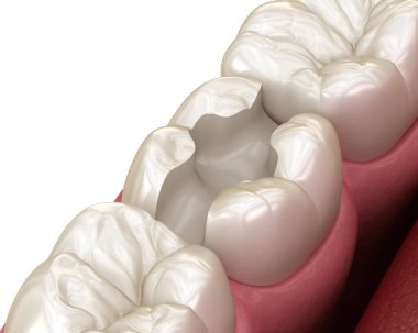 Inlay ceramic crown installation in to the tooth. Medically accurate 3D illustration of human teeth treatment clipart