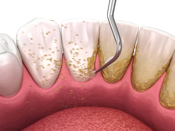 Oral Hygiene Scaling Root Planing Conventional Periodontal Therapy Medically Accurate — Stock Photo, Image