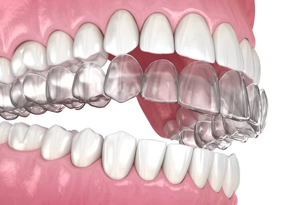 Invisalign Aparat Ortodontyczny Lub Niewidzialny Aparat Zęby Medycznie Dokładna Ilustracja — Zdjęcie stockowe