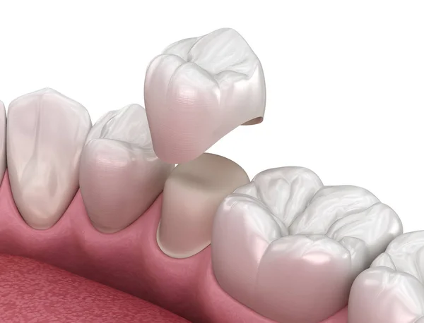 Preparato Dente Premolare Posizionamento Corona Dentale Illustrazione Clinicamente Accurata — Foto Stock