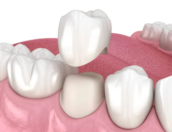 Preparated Premolar Tooth Dental Crown Placement Medically Accurate Illustration — Stock Photo, Image