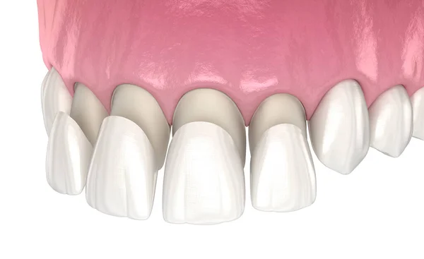 Veneer Installation Procedure Central Incisor Lateral Incisor Medically Accurate Tooth — Stock Photo, Image