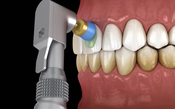 プロのブラシとゲルで歯研磨手順 医学的に正確な3Dイラスト — ストック写真