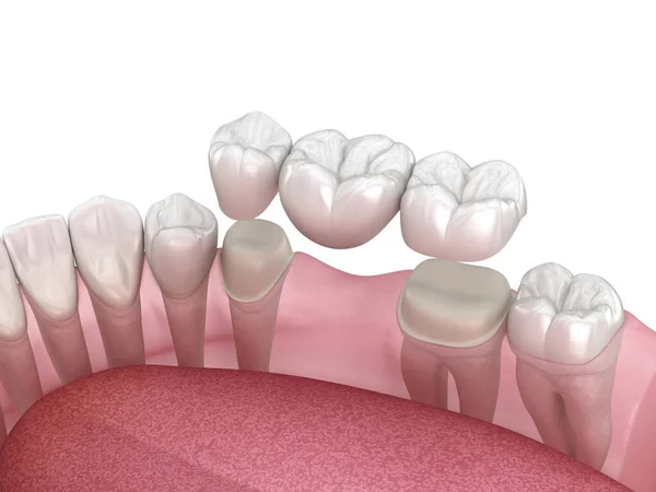 臼歯と前臼歯の上に3歯の歯科ブリッジ 人間の歯の治療の医学的に正確な3Dイラスト — ストック写真