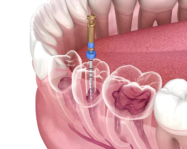 Endodontic root canal treatment process. Medically accurate tooth 3D illustration.