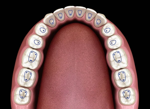 Root canal orifice locations plan of mandible jaw. 3D illustration