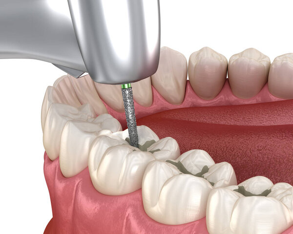 Подготовка трещин для размещения пломб, медицинская точность 3D иллюстрации концепции стоматологической системы